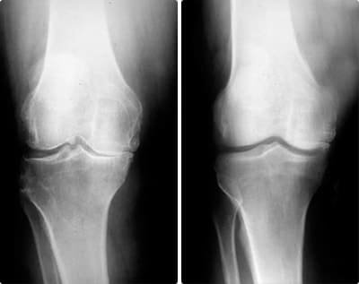 Before and after joint recovery in a professional athlete using Omnilar