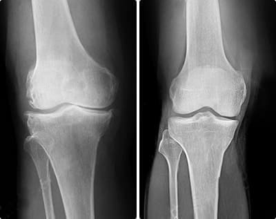 Before and after joint recovery in an active adult using Omnilar