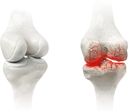 Diagram showing joint degeneration due to sports activities